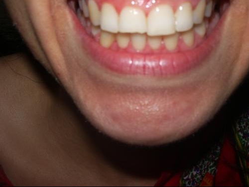 Dent Casseeeee Photos Avant Apres Beaute Des Dents Forum