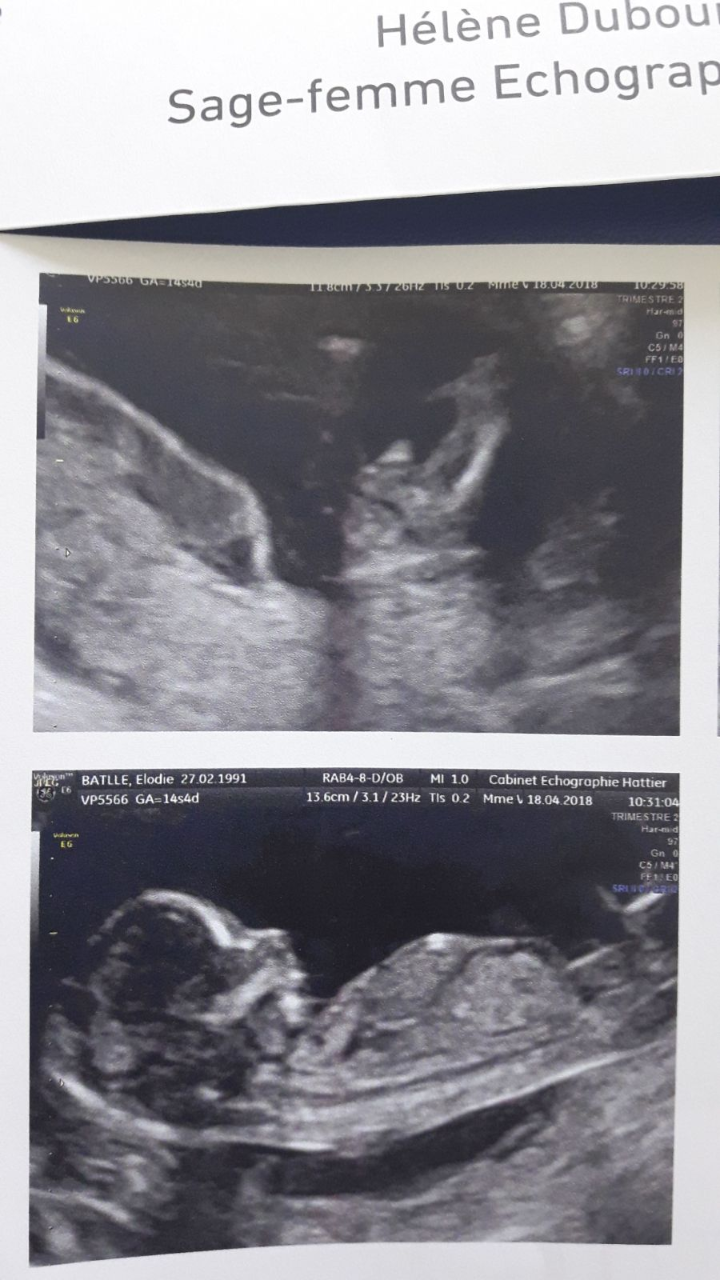 Fille Ou Garcon 14sa Echographie Connaitre Le Sexe De Votre Bebe Forum Grossesse Amp Bebe Doctissimo