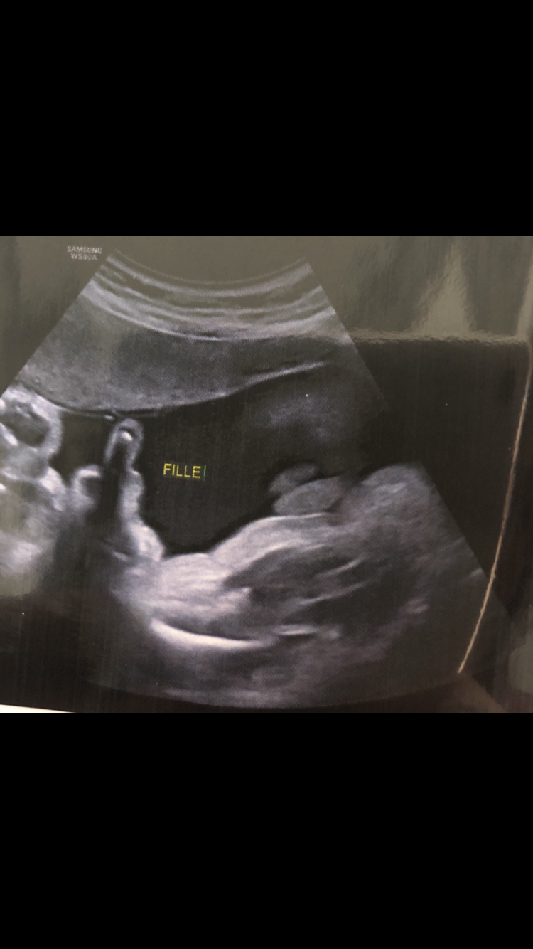 Doute Sur Sexe A Echo T3 Votre Avis Sur La Photo Echographie Connaitre Le Sexe De Votre Bebe Forum Grossesse Amp Bebe Doctissimo Doute Sur Sexe A Echo T3 Votre Avis Sur La Photo Echographie Connaitre Le Sexe De Votre Bebe Forum Grossesse Amp Bebe Doctissimo