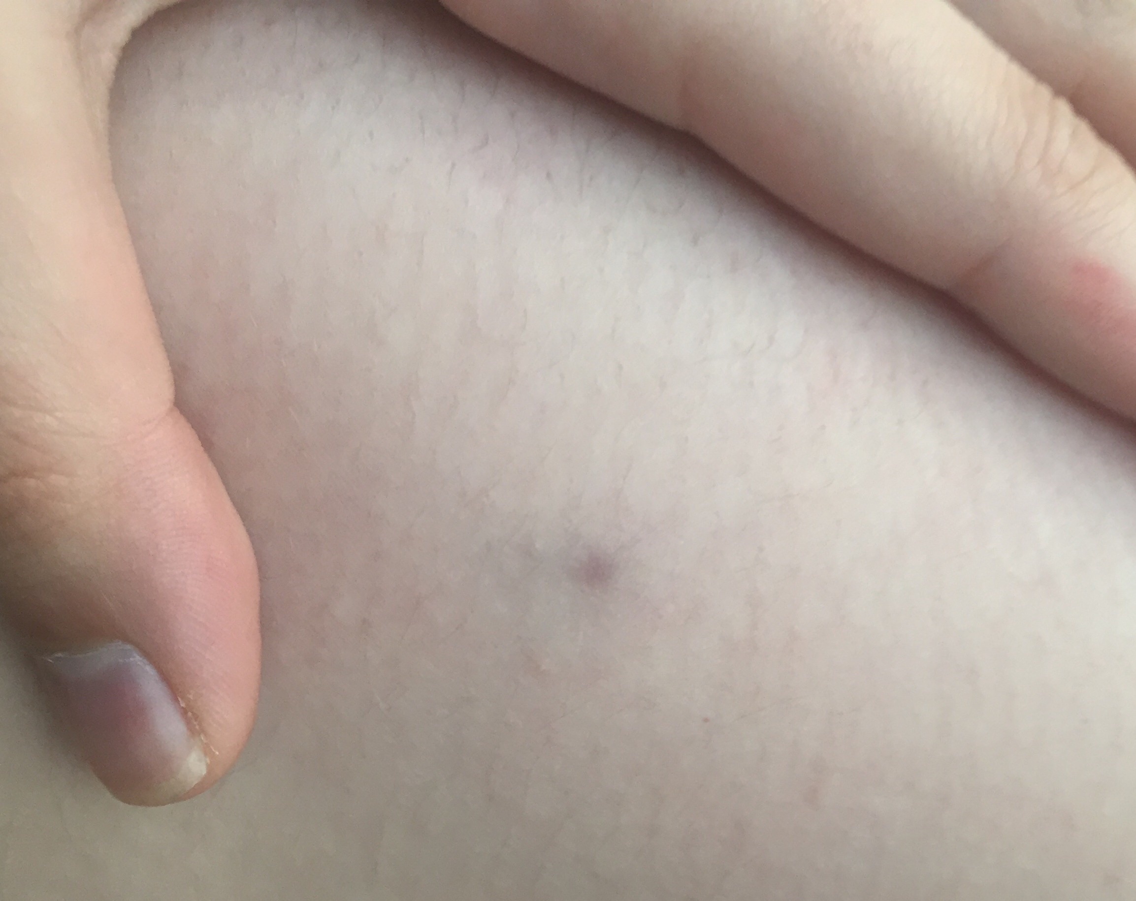 tache noire violette ronde sous la peau help forum libre sante forum sante doctissimo