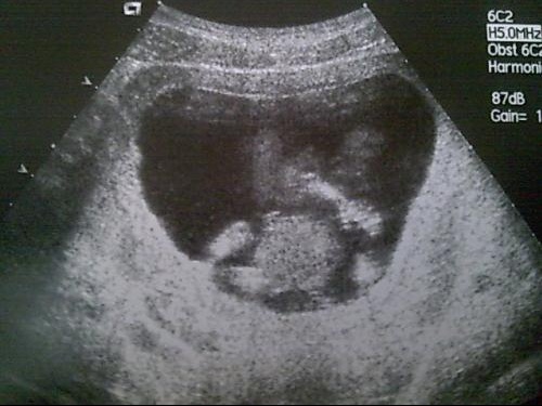 Euh C Est Quoi Siyouple Echographie Connaitre Le Sexe De Votre Bebe Forum Grossesse Amp Bebe Doctissimo