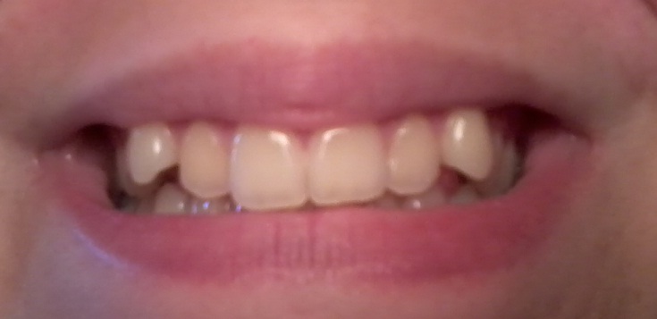 Orthodontie Ceramique Posee Beaute Des Dents Forum Beaute