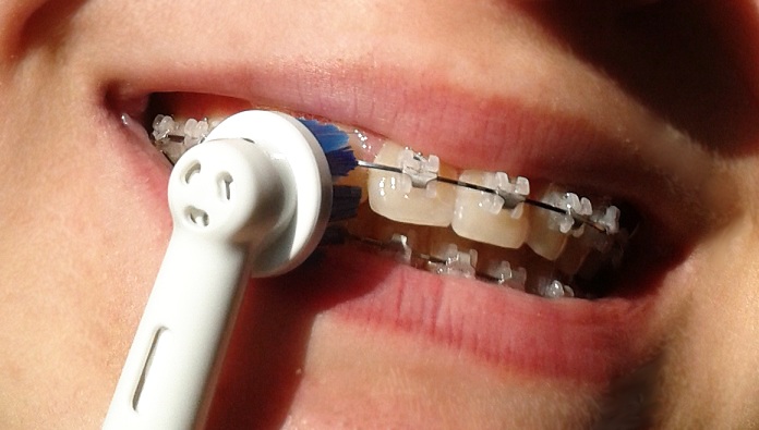 Orthodontie Ceramique Posee Page 4 Beaute Des Dents
