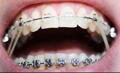 Elastique Pour La Machoire Problemes Dentaires Forum Sante