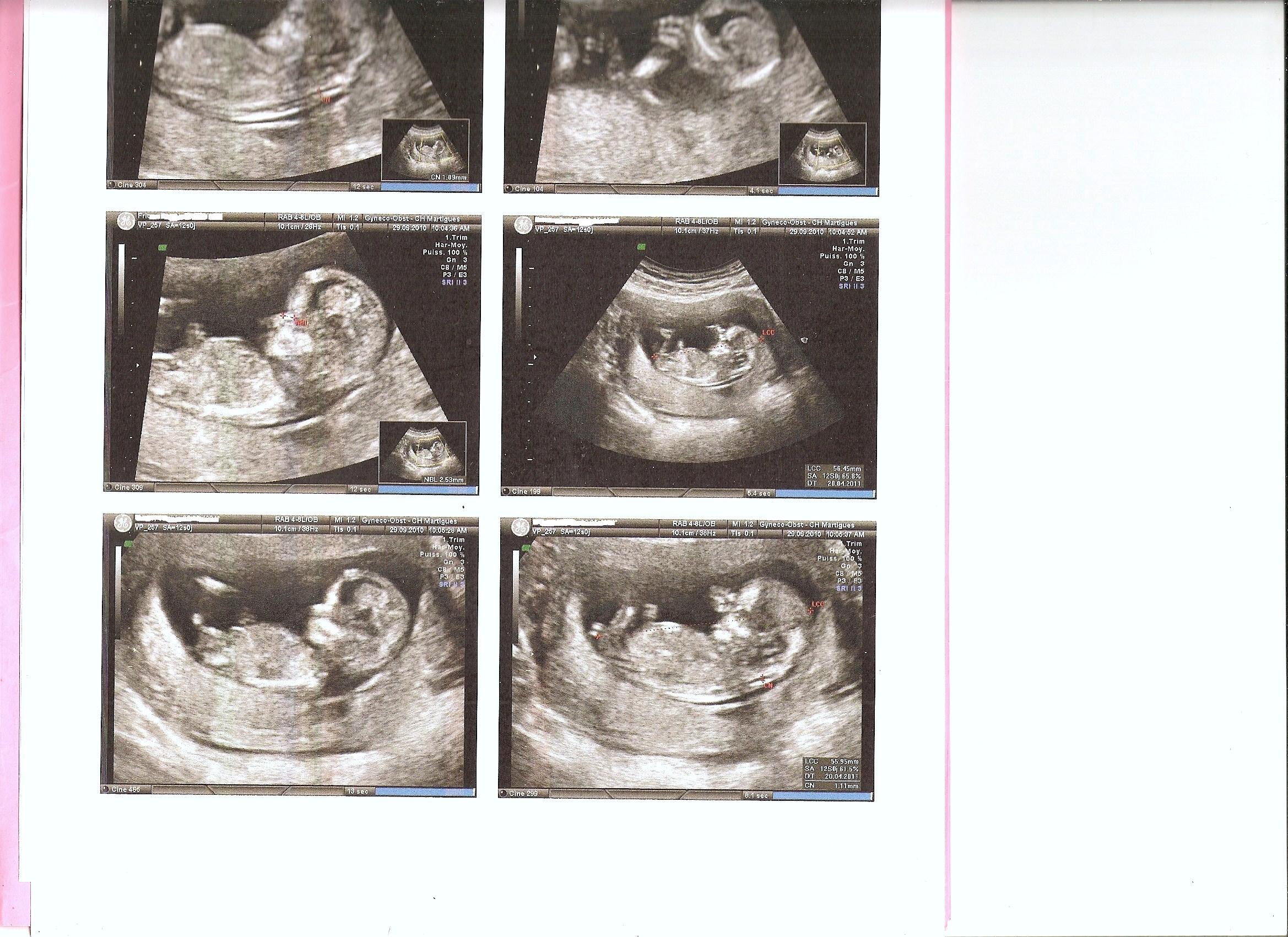 Et Moi A 31 Sa Je Le Sais Enfin Lol Echographie Connaitre Le Sexe De Votre Bebe Forum Grossesse Amp Bebe Doctissimo Et Moi A 31 Sa Je Le Sais Enfin Lol Echographie Connaitre Le Sexe De Votre Bebe Forum Grossesse Amp Bebe Doctissimo
