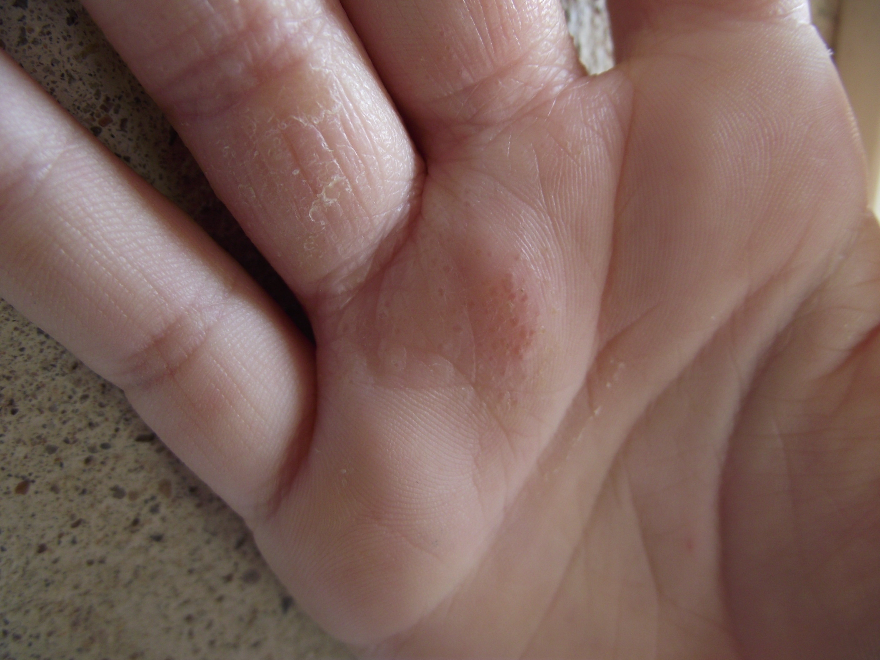 Boutons Sur Les Main De Ma Fille Qui Croutent Puis Pelent Acne Psoriasis Et Problemes De Peau Forum Sante Doctissimo Boutons Sur Les Main De Ma Fille Qui Croutent Puis Pelent Acne Psoriasis Et Problemes De Peau Forum Sante Doctissimo