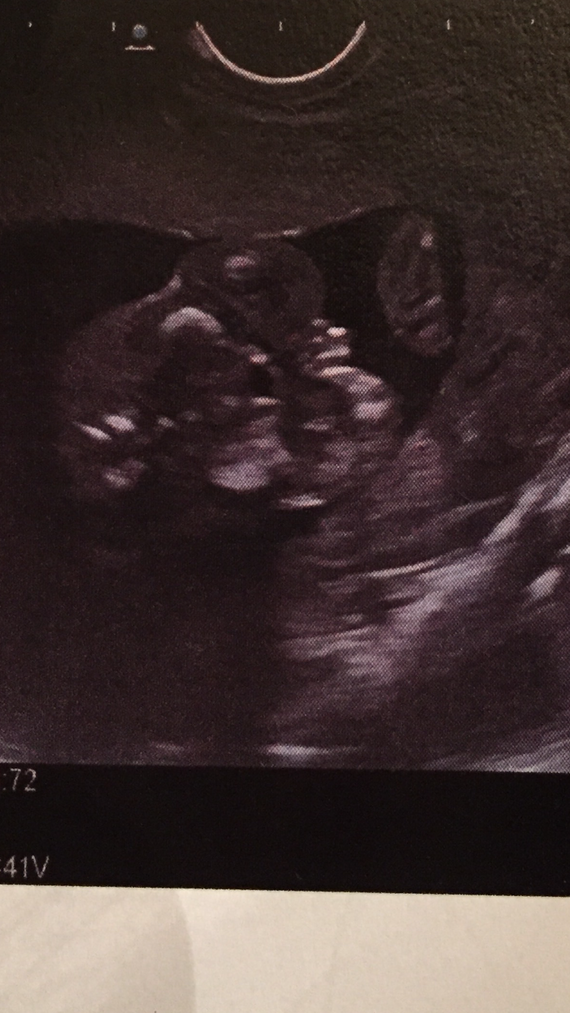 Echo Des 17 Sa Doute Sur Le Sexe Echographie Connaitre Le Sexe De Votre Bebe Forum Grossesse Amp Bebe Doctissimo Echo Des 17 Sa Doute Sur Le Sexe Echographie Connaitre Le Sexe De Votre Bebe Forum Grossesse Amp Bebe Doctissimo