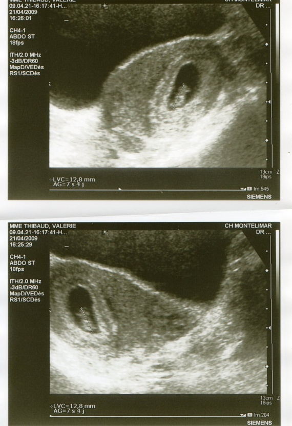 echo a 7sa+4j embryon de 8mm