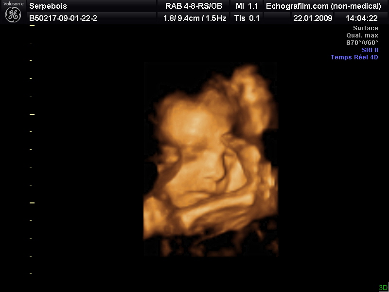 Mon Echo En 4d M Obsede Echographie Connaitre Le Sexe De Votre Bebe Forum Grossesse Amp Bebe Doctissimo Mon Echo En 4d M Obsede Echographie Connaitre Le Sexe De Votre Bebe Forum Grossesse Amp Bebe Doctissimo