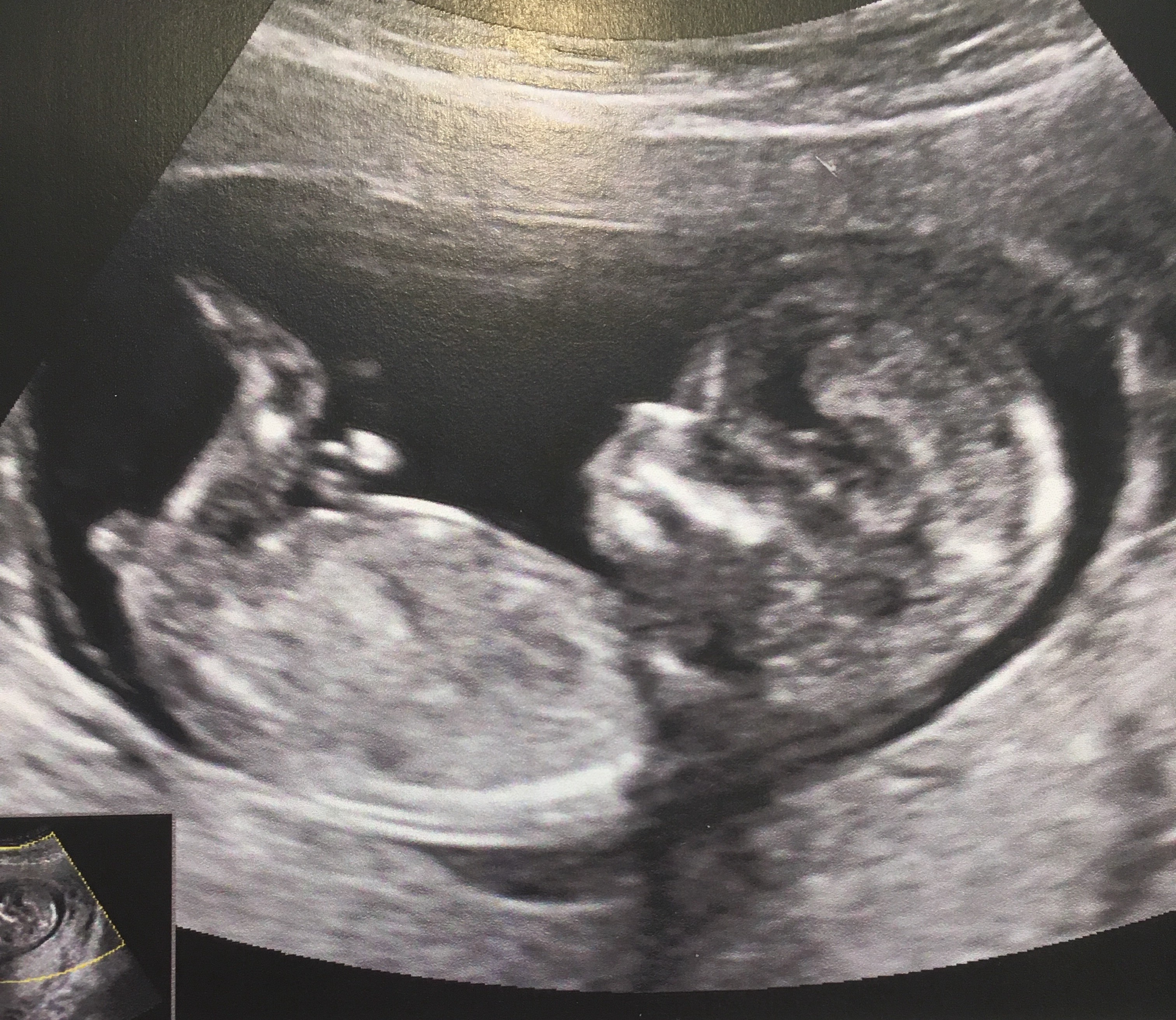 Avis Sexe Premiere Echographie Echographie Connaitre Le Sexe De Votre Bebe Forum Grossesse Amp Bebe Doctissimo Avis Sexe Premiere Echographie Echographie Connaitre Le Sexe De Votre Bebe Forum Grossesse Amp Bebe Doctissimo