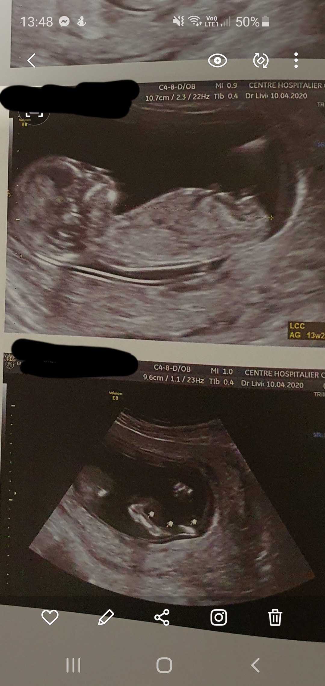 Bourgeon Tendancieux 13sa 2 Echographie Connaitre Le Sexe De Votre Bebe Forum Grossesse Amp Bebe Doctissimo Bourgeon Tendancieux 13sa 2 Echographie Connaitre Le Sexe De Votre Bebe Forum Grossesse Amp Bebe Doctissimo