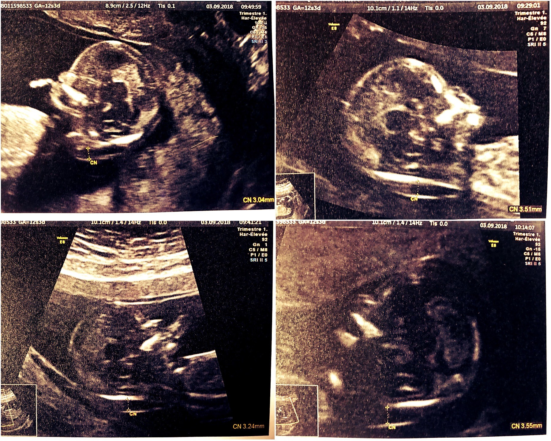 Clarte Nucale 3 51mm Amniocentese Forum Grossesse Amp Bebe Doctissimo Clarte Nucale 3 51mm Amniocentese Forum Grossesse Amp Bebe Doctissimo