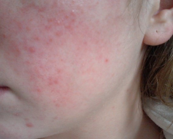 Acnée rosacée, erythrose..??