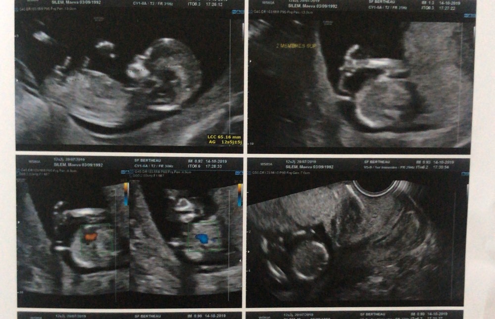 Echo 12s 4 Avis Fille Ou Garcon Echographie Connaitre Le Sexe De Votre Bebe Forum Grossesse Amp Bebe Doctissimo Echo 12s 4 Avis Fille Ou Garcon Echographie Connaitre Le Sexe De Votre Bebe Forum Grossesse Amp Bebe Doctissimo