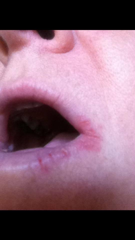 Levres Tres Gercees Saignements Depuis 2 Ans Aidez Moi