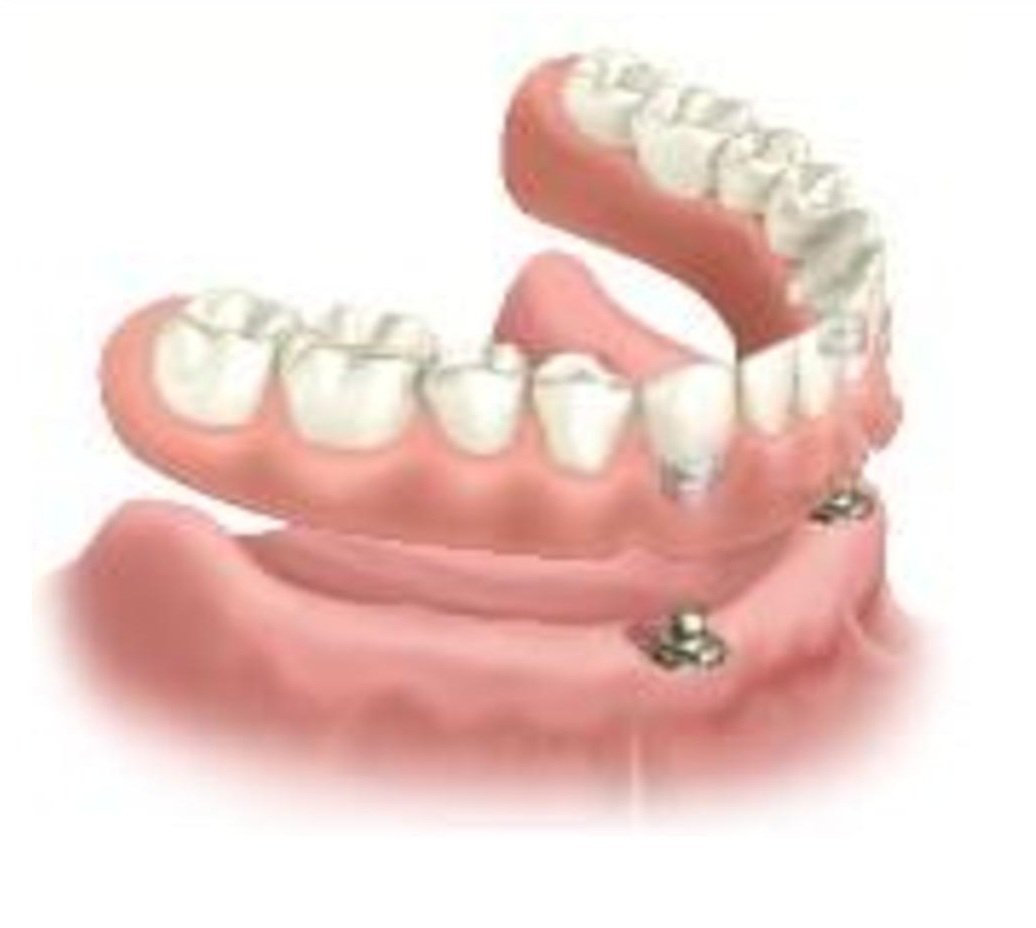 Dentier Fixe Forum . Lorsque Je Ne L�aurai Plus, Je Compte Me Faire Faire Un Dentier, J�aimerai Des Renseignements Sur Les Prix Sachant Que Je Me Fais Soigner En Milieu Hospitalier.merci.