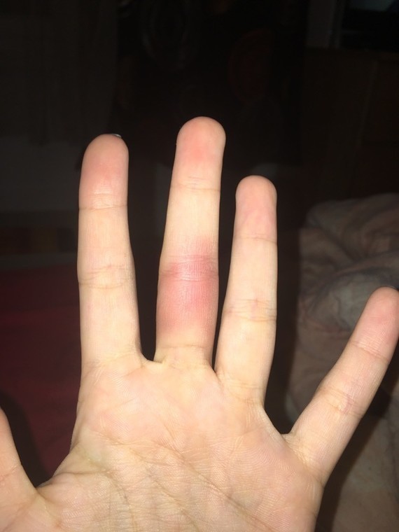 veines et vaisseaux qui "éclatent" puis hématome