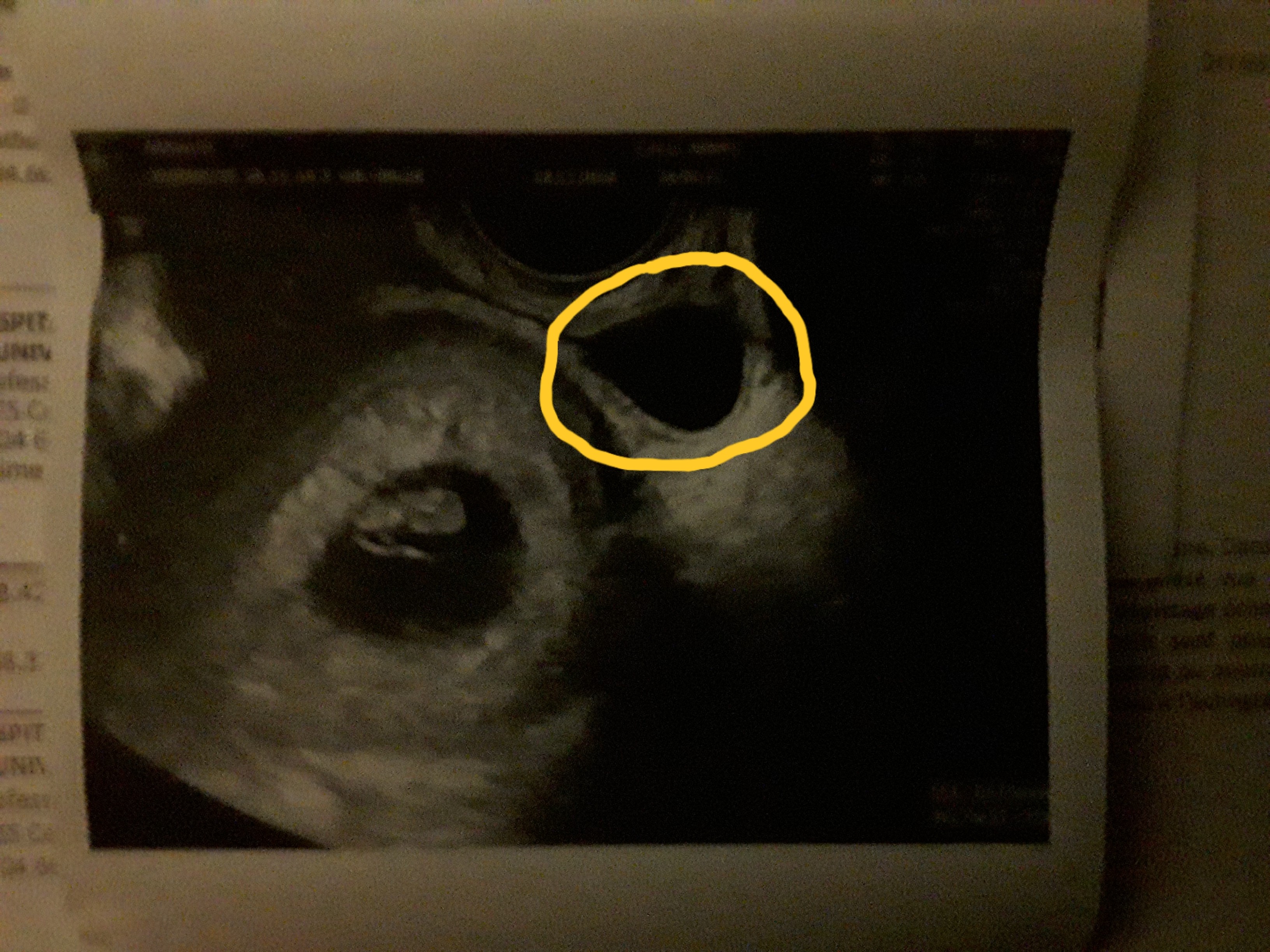 Echographie 7sa 3 Deuxieme Sac Echographie Connaitre Le Sexe De Votre Bebe Forum Grossesse Amp Bebe Doctissimo Echographie 7sa 3 Deuxieme Sac Echographie Connaitre Le Sexe De Votre Bebe Forum Grossesse Amp Bebe Doctissimo