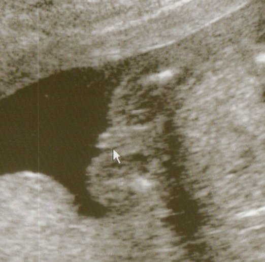 Je Sais Enfin Le Sexe De A 19sa Echographie Connaitre Le Sexe De Votre Bebe Forum Grossesse Amp Bebe Doctissimo Je Sais Enfin Le Sexe De A 19sa Echographie Connaitre Le Sexe De Votre Bebe Forum Grossesse Amp Bebe Doctissimo
