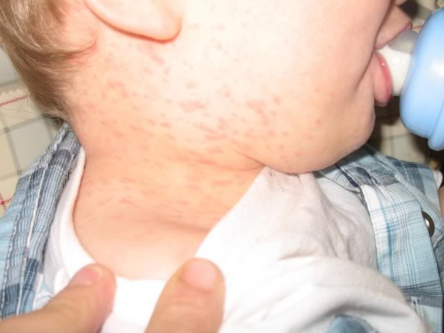 Allergie Au Biaxin Ou Rougeole Mamans Et Futures Mamans Du Quebec Forum Grossesse Amp Bebe Doctissimo Allergie Au Biaxin Ou Rougeole Mamans Et Futures Mamans Du Quebec Forum Grossesse Amp Bebe Doctissimo