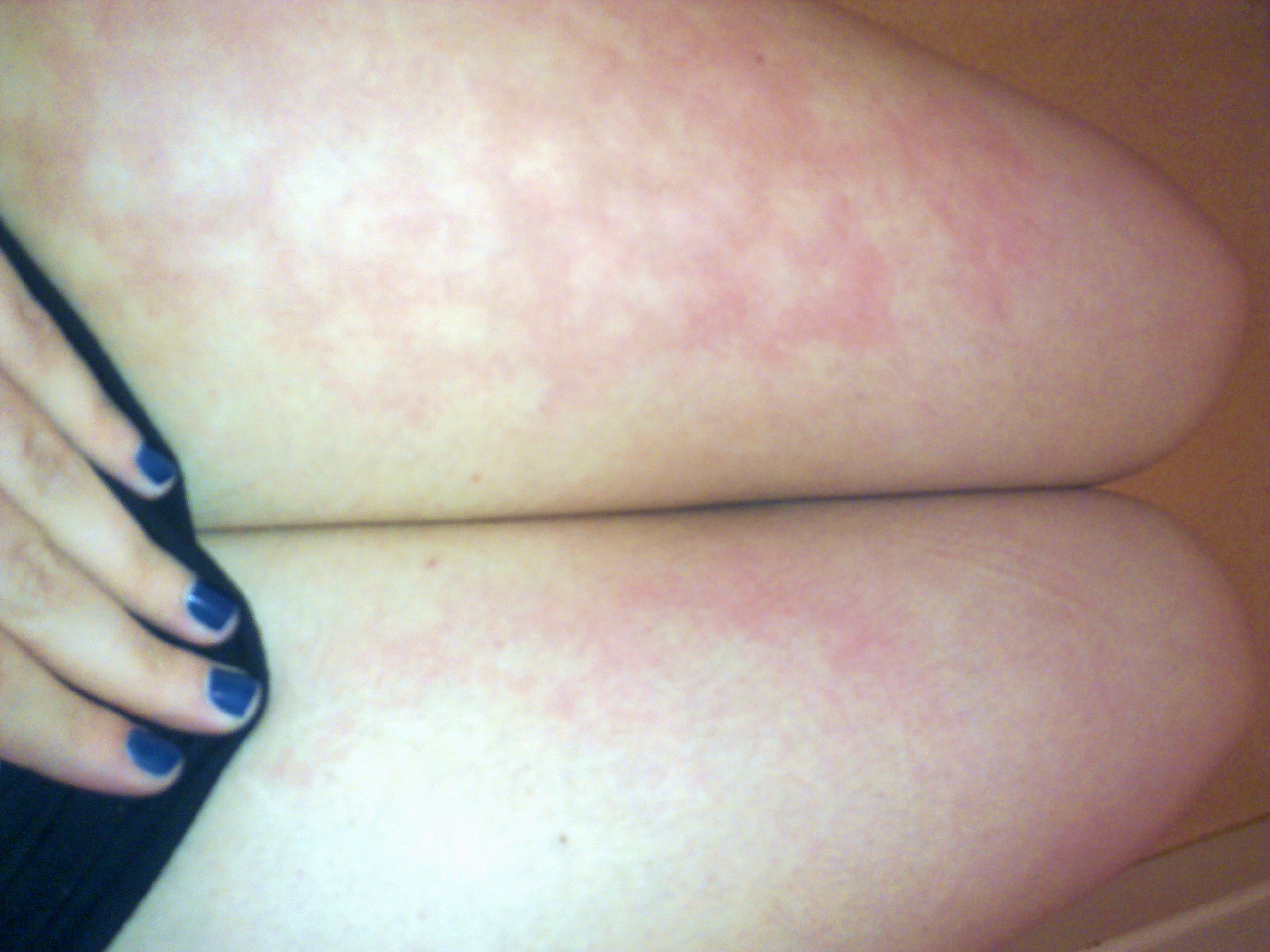 Plaque Marbree Sur La Peau Allergies Et Eczema Forum Sante Doctissimo Plaque Marbree Sur La Peau Allergies Et Eczema Forum Sante Doctissimo