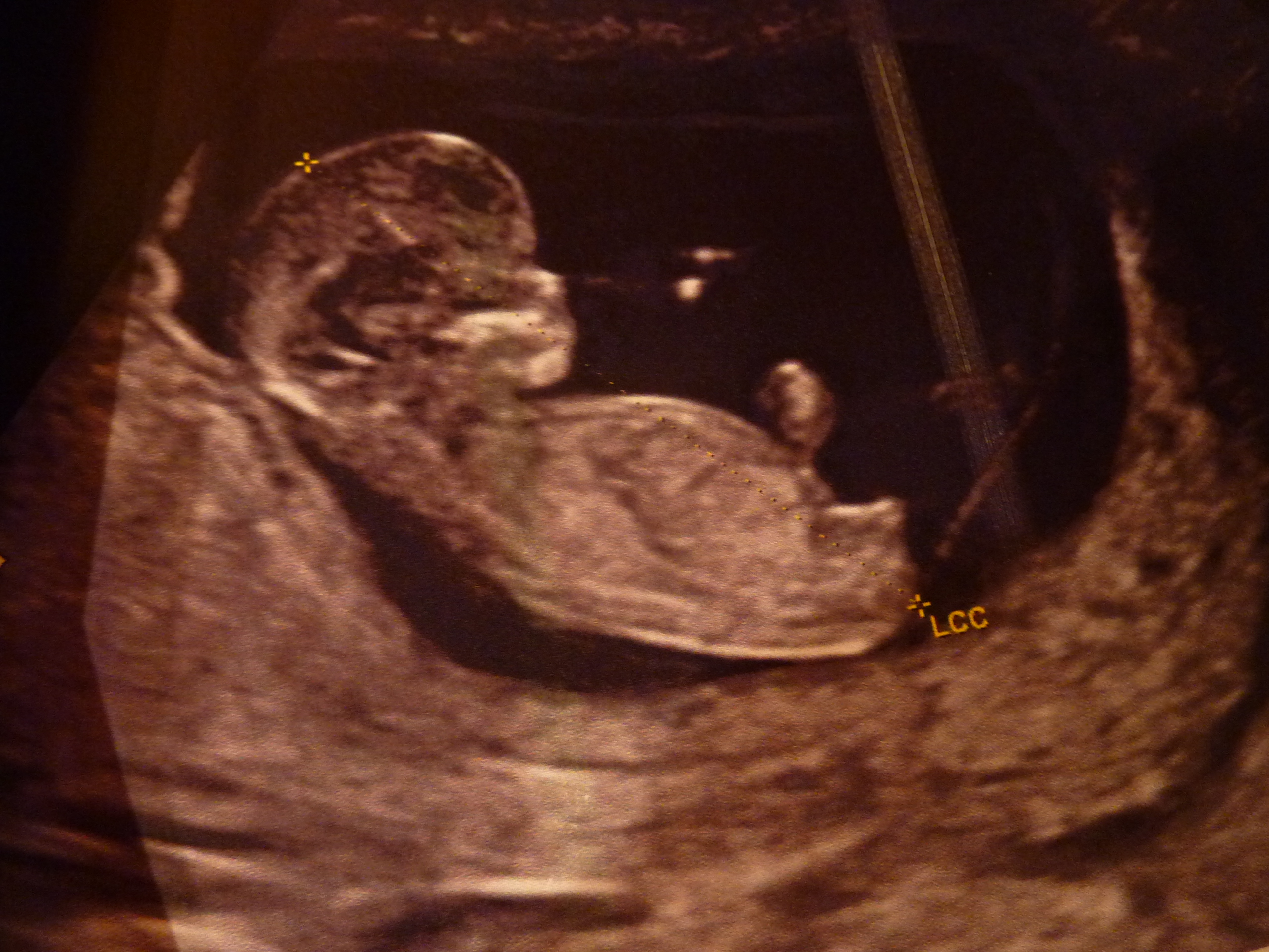 Avis Aux Expertes Sur Tubercule Genital Echo 12 Sa Echographie Connaitre Le Sexe De Votre Bebe Forum Grossesse Amp Bebe Doctissimo Avis Aux Expertes Sur Tubercule Genital Echo 12 Sa Echographie Connaitre Le Sexe De Votre Bebe Forum Grossesse Amp Bebe Doctissimo