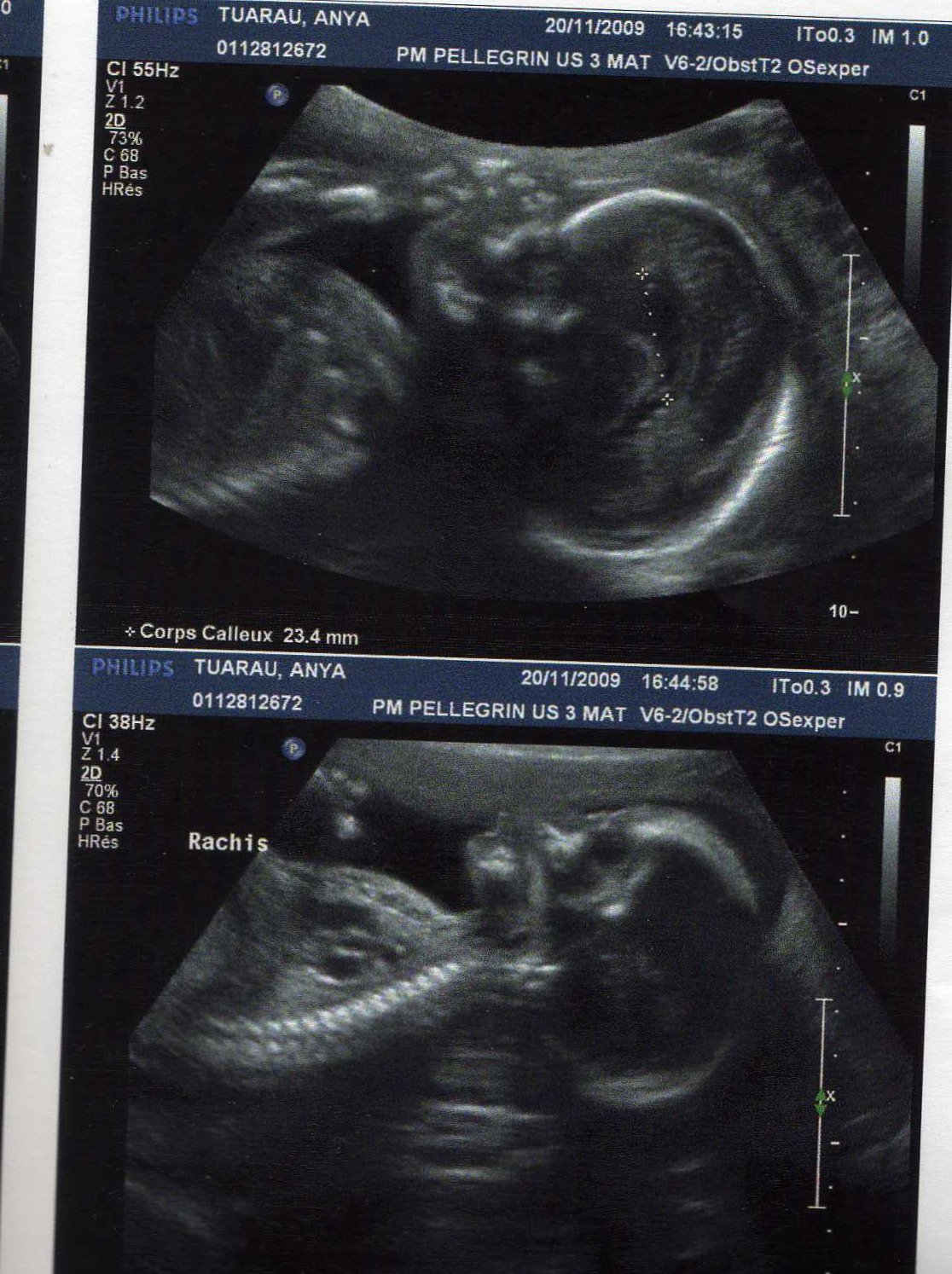 Compte Rendus De La 2eme Echo Par Ici Futures Mamans Forum Grossesse Amp Bebe Doctissimo Compte Rendus De La 2eme Echo Par Ici Futures Mamans Forum Grossesse Amp Bebe Doctissimo