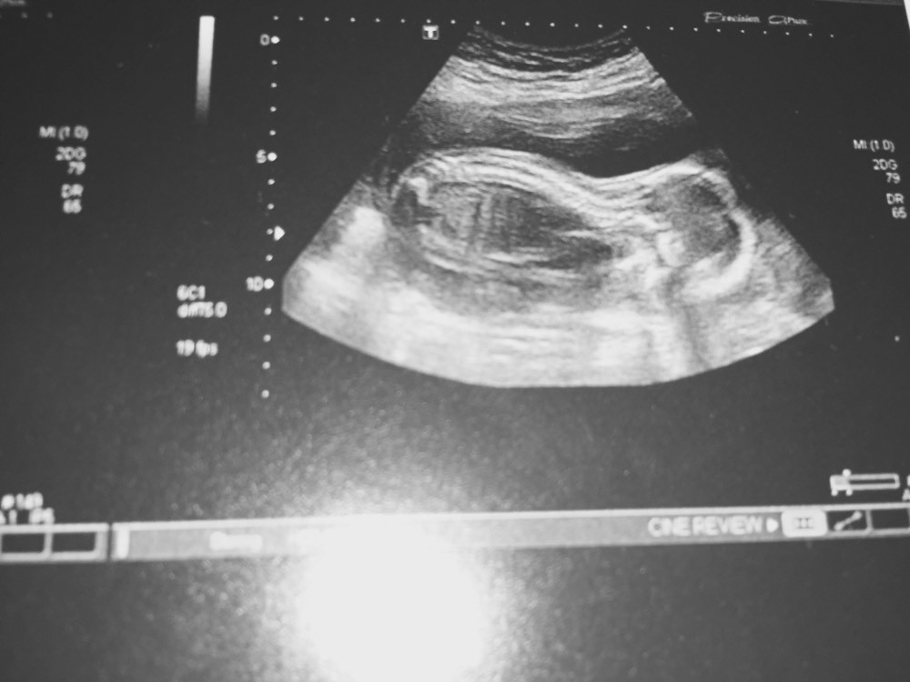 Echographie 18 Sa Quelque Chose M Interpelle Echographie Connaitre Le Sexe De Votre Bebe Forum Grossesse Amp Bebe Doctissimo
