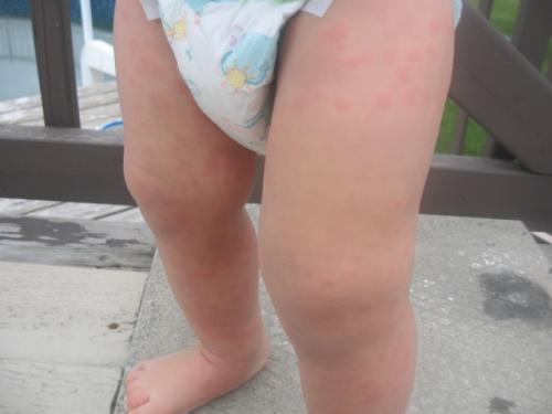 Reaction Allergique Photos Nouvelle Mamans Et Futures Mamans Du Quebec Forum Grossesse Amp Bebe Doctissimo Reaction Allergique Photos Nouvelle Mamans Et Futures Mamans Du Quebec Forum Grossesse Amp Bebe Doctissimo