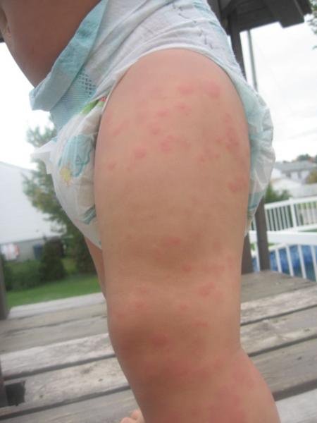 Reaction Allergique Photos Nouvelle Mamans Et Futures Mamans Du Quebec Forum Grossesse Amp Bebe Doctissimo Reaction Allergique Photos Nouvelle Mamans Et Futures Mamans Du Quebec Forum Grossesse Amp Bebe Doctissimo