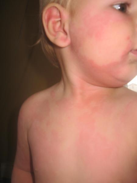 Reaction Allergique Photos Nouvelle Mamans Et Futures Mamans Du Quebec Forum Grossesse Amp Bebe Doctissimo Reaction Allergique Photos Nouvelle Mamans Et Futures Mamans Du Quebec Forum Grossesse Amp Bebe Doctissimo