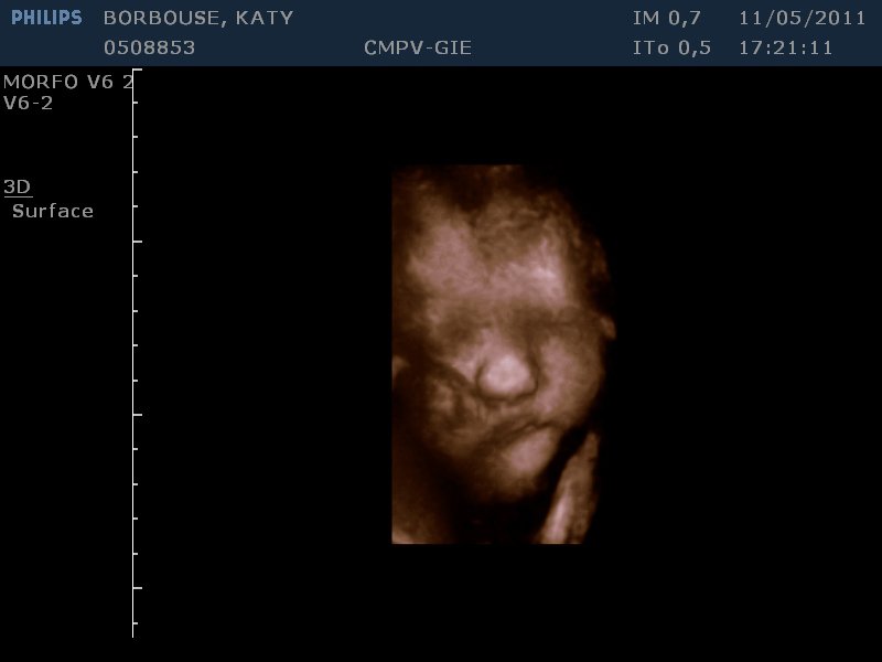 Echo Du Visage 3d Inquiete Echographie Connaitre Le Sexe De Votre Bebe Forum Grossesse Amp Bebe Doctissimo