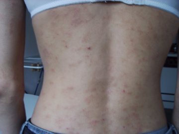 Evolution D Un Eczema Allergique Allergies Et Eczema Forum Sante Doctissimo