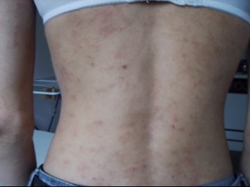 Evolution D Un Eczema Allergique Allergies Et Eczema Forum Sante Doctissimo Evolution D Un Eczema Allergique Allergies Et Eczema Forum Sante Doctissimo