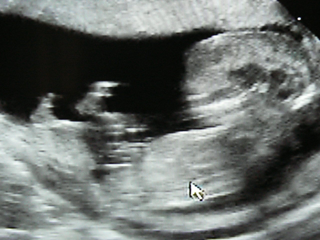 Echo A 12sa 1j J Ai Le Verdict Echographie Connaitre Le Sexe De Votre Bebe Forum Grossesse Amp Bebe Doctissimo