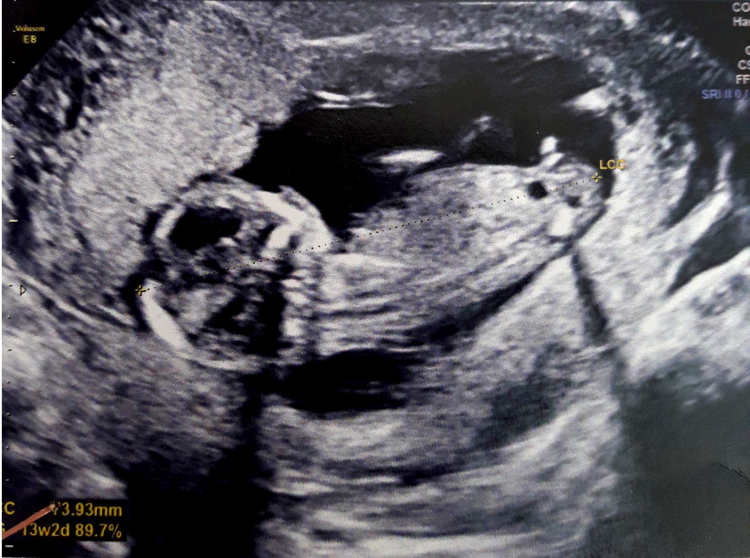 Bourgeon Genital Echo 13 Sa 2 J Besoin D Un Max D Avis Sur Le Sexe Echographie Connaitre Le Sexe De Votre Bebe Forum Grossesse Amp Bebe Doctissimo Bourgeon Genital Echo 13 Sa 2 J Besoin D Un Max D Avis Sur Le Sexe Echographie Connaitre Le Sexe De Votre Bebe Forum Grossesse Amp Bebe Doctissimo