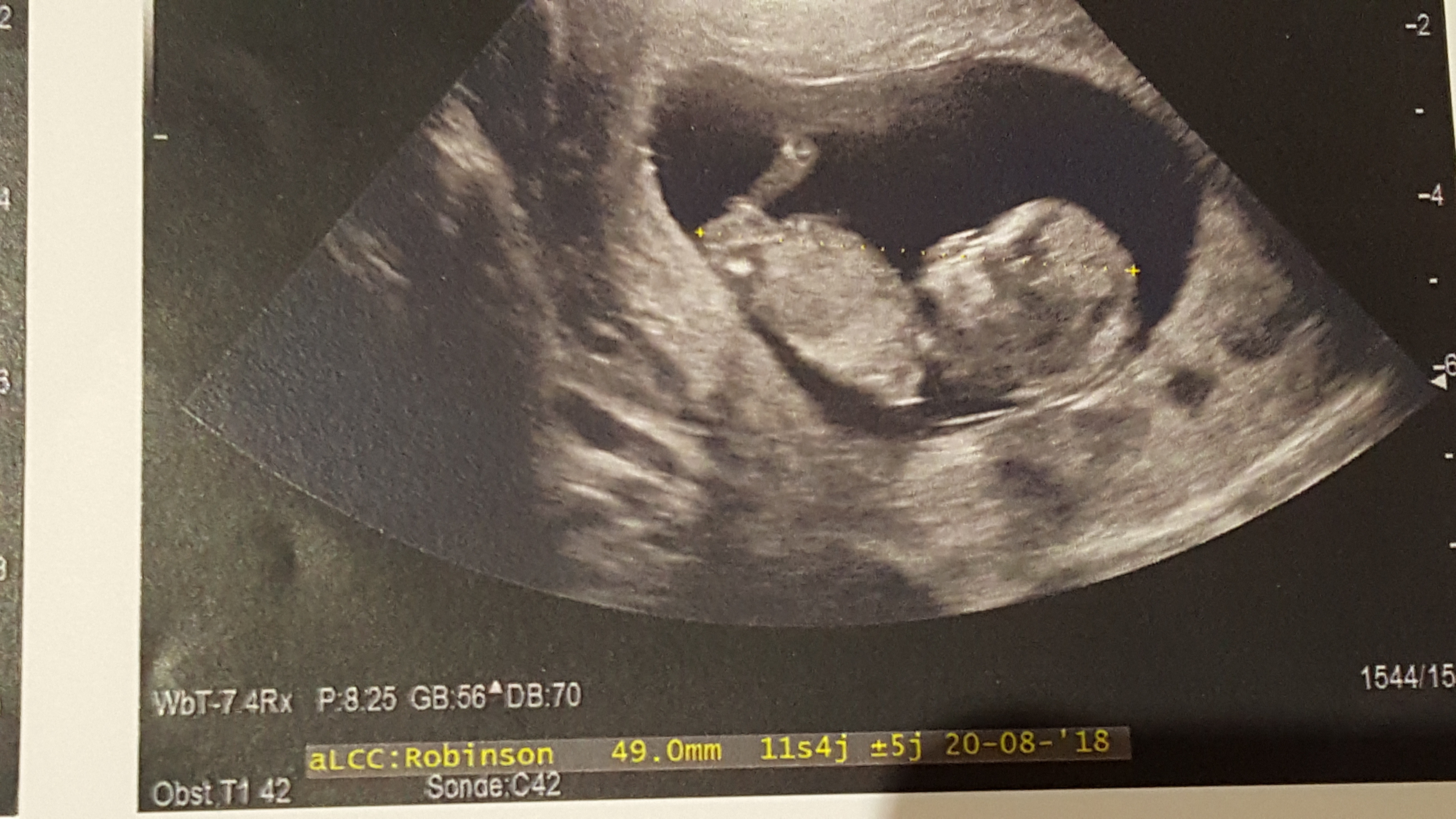 Avis 11sa 2 Echographie Connaitre Le Sexe De Votre Bebe Forum Grossesse Amp Bebe Doctissimo