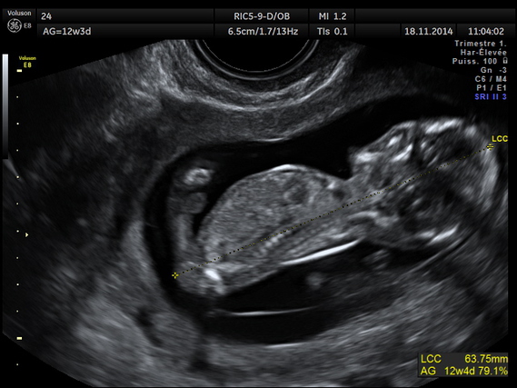 12sa 5 Jours Grossesse 3 Marion 2 Photos Club Doctissimo 12sa 5 Jours Grossesse 3 Marion 2 Photos Club Doctissimo