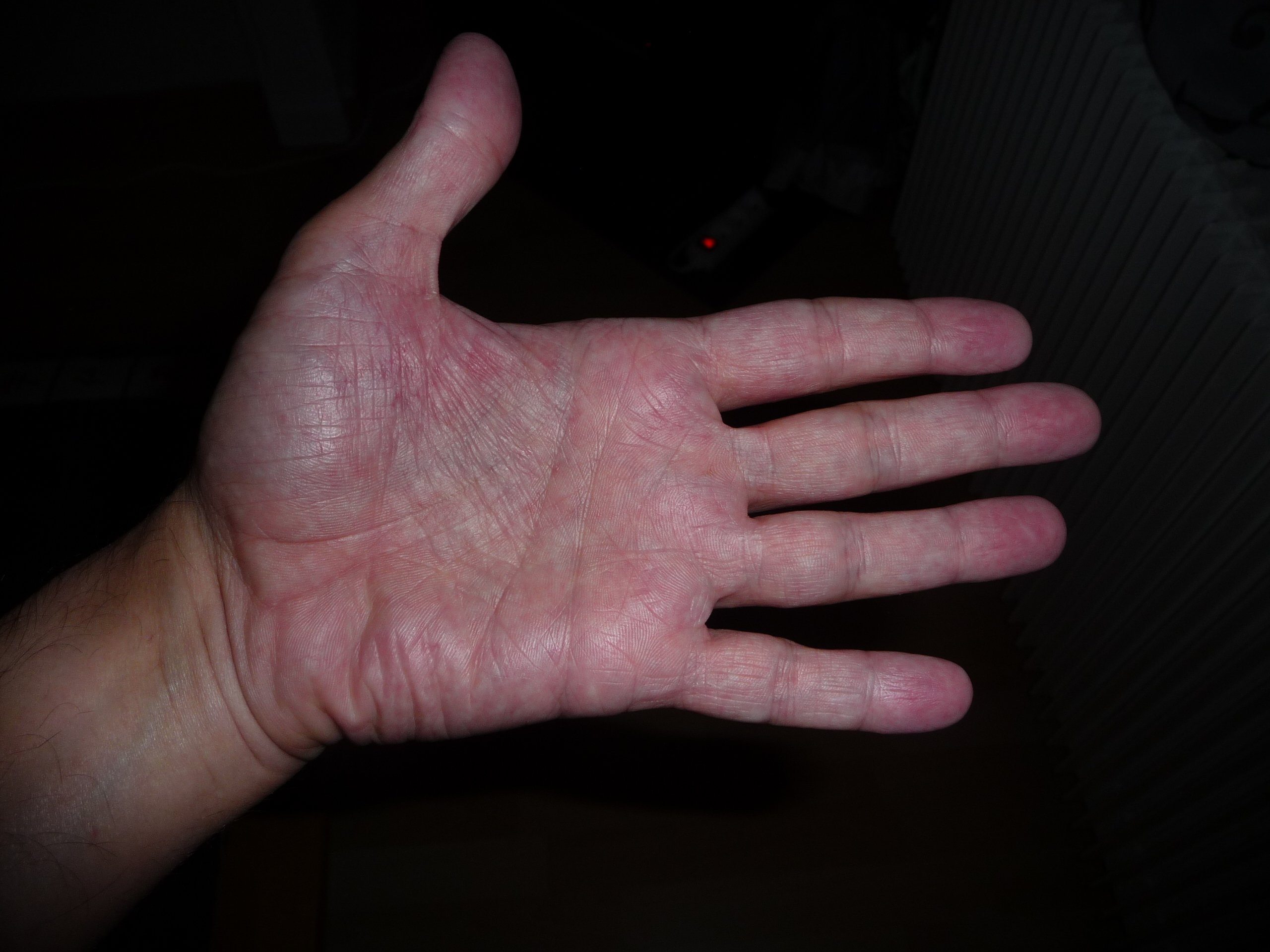 Paumes Des Mains Tres Chaude Avec Des Points Rouges Et Picotements Acne Psoriasis Et Problemes De Peau Forum Sante