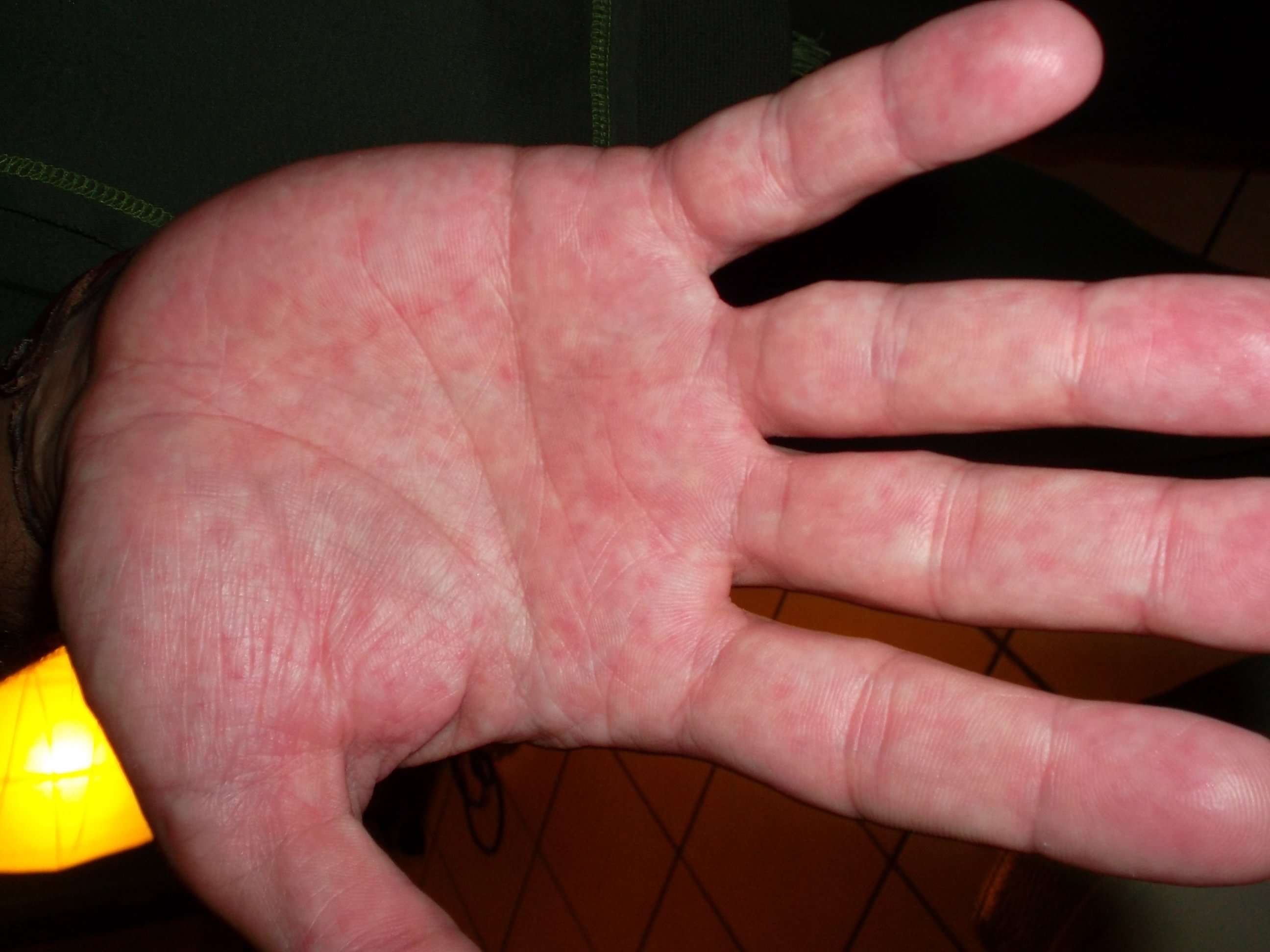Paumes Des Mains Tres Chaude Avec Des Points Rouges Et Picotements Acne Psoriasis Et Problemes De Peau Forum Sante