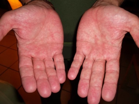 Paumes des mains trés chaude, avec des points rouges et picotements