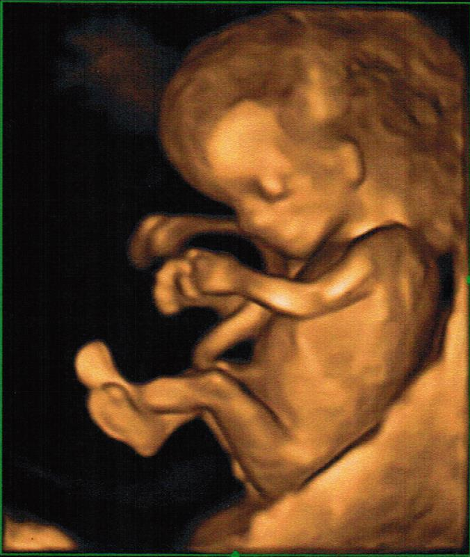Mon Echo 3d A 12 Sa Fille Ou Garcon Echographie Connaitre Le Sexe De Votre Bebe Forum Grossesse Amp Bebe Doctissimo Mon Echo 3d A 12 Sa Fille Ou Garcon Echographie Connaitre Le Sexe De Votre Bebe Forum Grossesse Amp Bebe Doctissimo