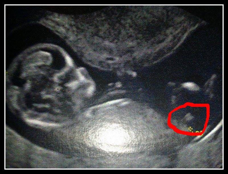 Finalement On A Decider De Garder La Surprise Pour Ce Dernier Bebe Echographie Connaitre Le Sexe De Votre Bebe Forum Grossesse Amp Bebe Doctissimo