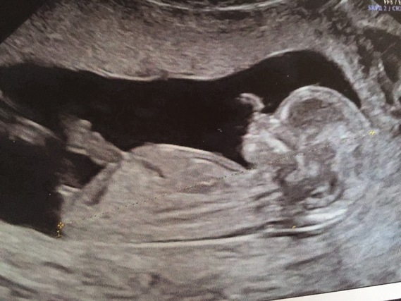 Deni De Grossesse Se Voit Sur Un Test Echo à 13 SA - A votre avis ? Fille ou garçon - Echographie - connaître