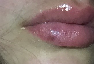 Tache Bleu Sur La Levre Acne Psoriasis Et Problemes De Peau Forum Sante Doctissimo Tache Bleu Sur La Levre Acne Psoriasis Et Problemes De Peau Forum Sante Doctissimo