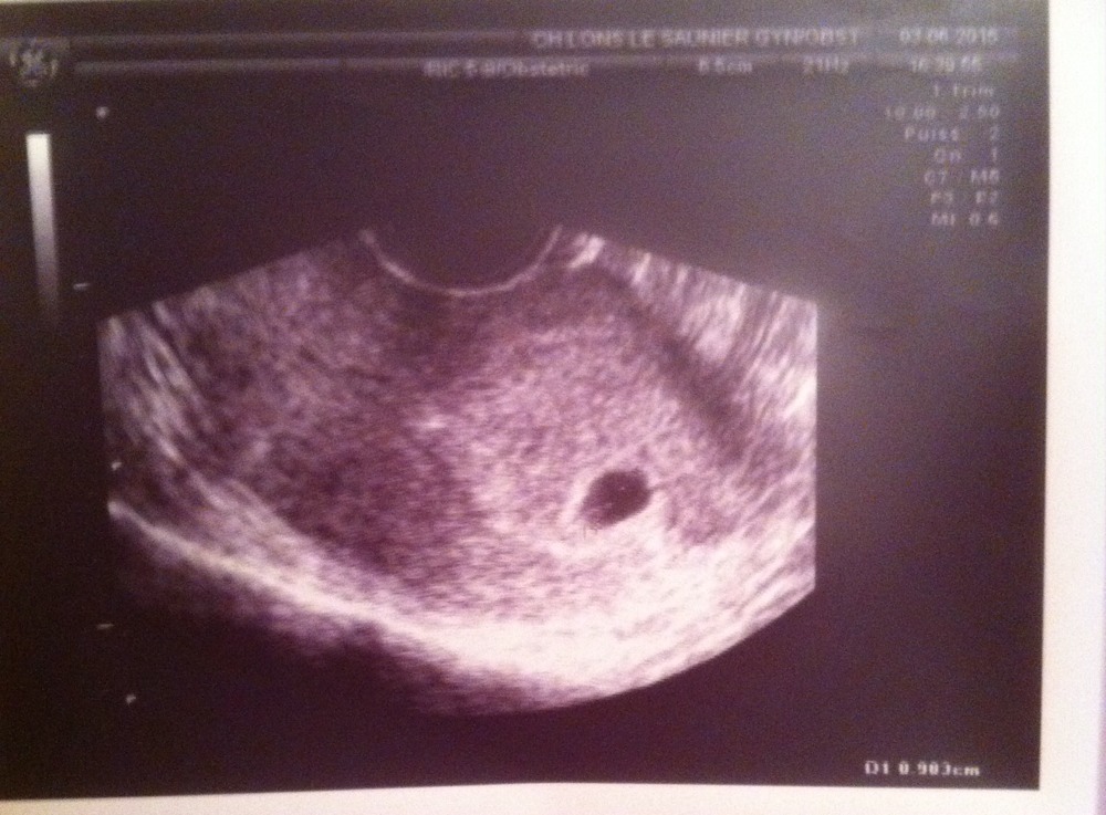 Est Ce Normal De Ne Pas Voir D Embryon A 5 Semaines De Grossesses Est Ce Normal De Ne Pas Voir D Embryon A 5 Semaines De Grossesses