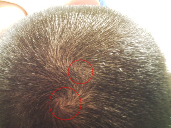 Tourbillons Sur Ma Tete Calvitie Et Perte De Cheveux Forum Sante Doctissimo