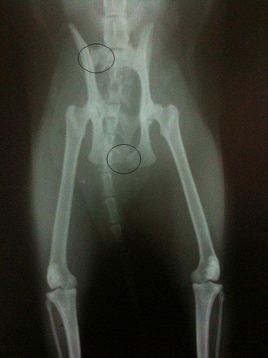 Fracture Du Bassin Fracture Du Bassin