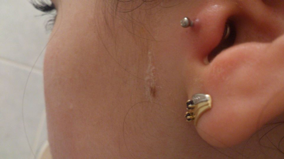 Piercing Tragus Cheloide Tatouages Et Piercings Forum Beaute Doctissimo