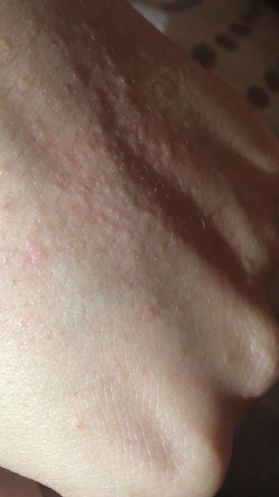Petits Boutons Dos De La Main Acne Psoriasis Et Problemes De Peau Forum Sante Doctissimo